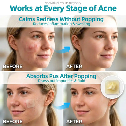 Stemhalo Hydrocolloid Acne Patch | Treat Pimples, Repair Wounds & Fade Acne Marks