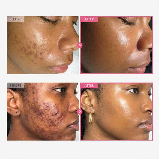 Stemhalo Alpha Arbutin+TXA Brightening Cream | Rapidly Fade Freckles, Acne Scars & Melasma, Reveal Luminous Glass Skin
