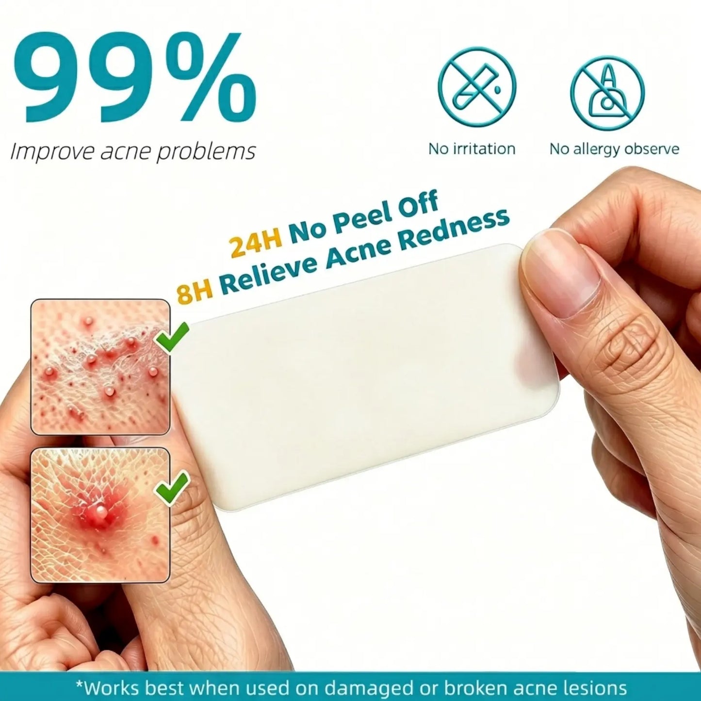 Stemhalo Hydrocolloid Acne Patch | Treat Pimples, Repair Wounds & Fade Acne Marks