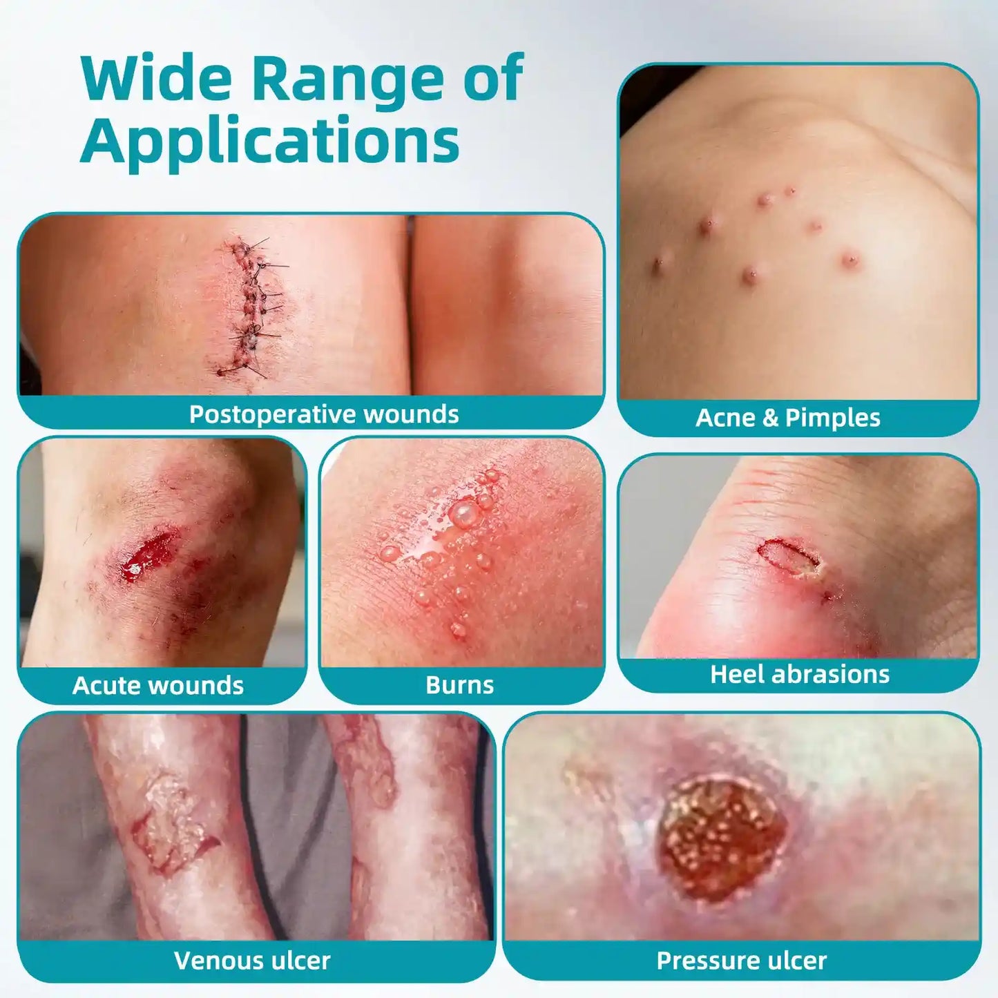 Stemhalo Hydrocolloid Acne Patch | Treat Pimples, Repair Wounds & Fade Acne Marks