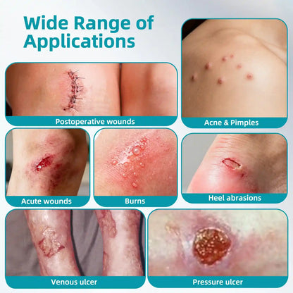 Stemhalo Hydrocolloid Acne Patch | Treat Pimples, Repair Wounds & Fade Acne Marks