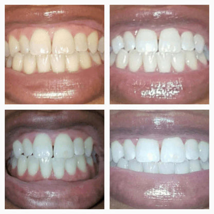 Stemhalo Teeth Whitening Serum Pen Whiten Teeth & Remove Stains